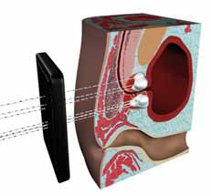Figur 2. Illustrasjon av nålenes gjennomgang av templaten og plassering i prostata under pågående frysing