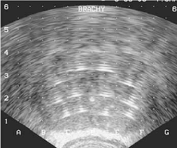 Bilde 4. Ultrasonografisk tverrsnitt av prostata som viser ekko fra kryonålene og fra guidewire i urethra.