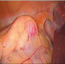Bilde 6. Laproskopisk bilde av høyresidig nyretumor før fridisseksjon