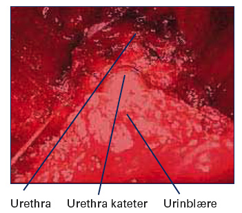 Bilde 2. LRP. Anastomose mellom urethra og blære snart fullført. Eksempel på det gode innsyn ved laparoskopisk kirurgi