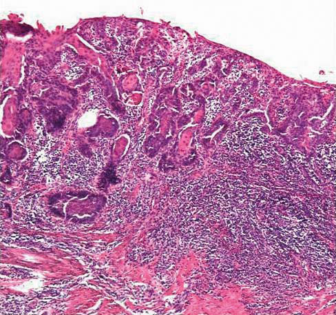 Bilde 2a. Mikroskopisk bilde som viser grov dysplasi gjennom hele epitelets tykkelse med opphevet lagdeling, forenlig med carcinoma in situ. Noter intakt basalmembran (se pil). Hematoxylin-Eosin fargning av biopsi fra penis x 40.