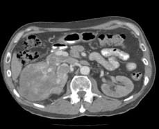 Figur 1a. CT snittet viser en 10 cm stor svulst i hø. nyre. Man ser også en tumortrombe som vokser helt inn til Vena Cava Inferior (VCI).
