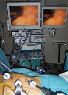 Bilde 3b. Kirurgens perspektiv ved laparoskopisk radikal nefrektomi