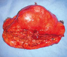 Bilde 4. Et RN-(Radikal nefrektomi) preparat slik det ser ut før oppskjæring og fiksering. Gerotas fascie er intakt over svulsten. Den gule knappenålen markerer ureter, den blå markerer nyrevenen og den røde (Vanskelig å se) viser arterien.