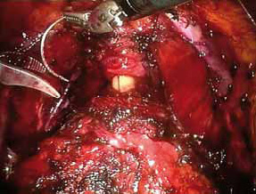 Bilde 5: Suturering av plexus Santorini. Apex prostata og urethra med kateter.