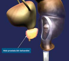 Figur 4. High Intensity Focused Ultrasound (HIFU): Rectal ultralyd probe destruerer prostata cancer